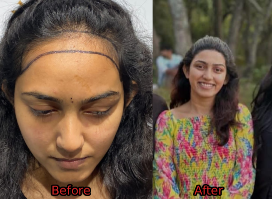 Hair Transplant Result 1